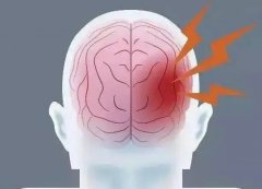 偏頭痛神經性頭疼怎么治療